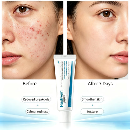 Hushvein TX Cream 50ml, Tranexamic Acid & Niacinamide Dark Spot & Hyperpigmentation Care– Fades Breakouts & Restores Skin