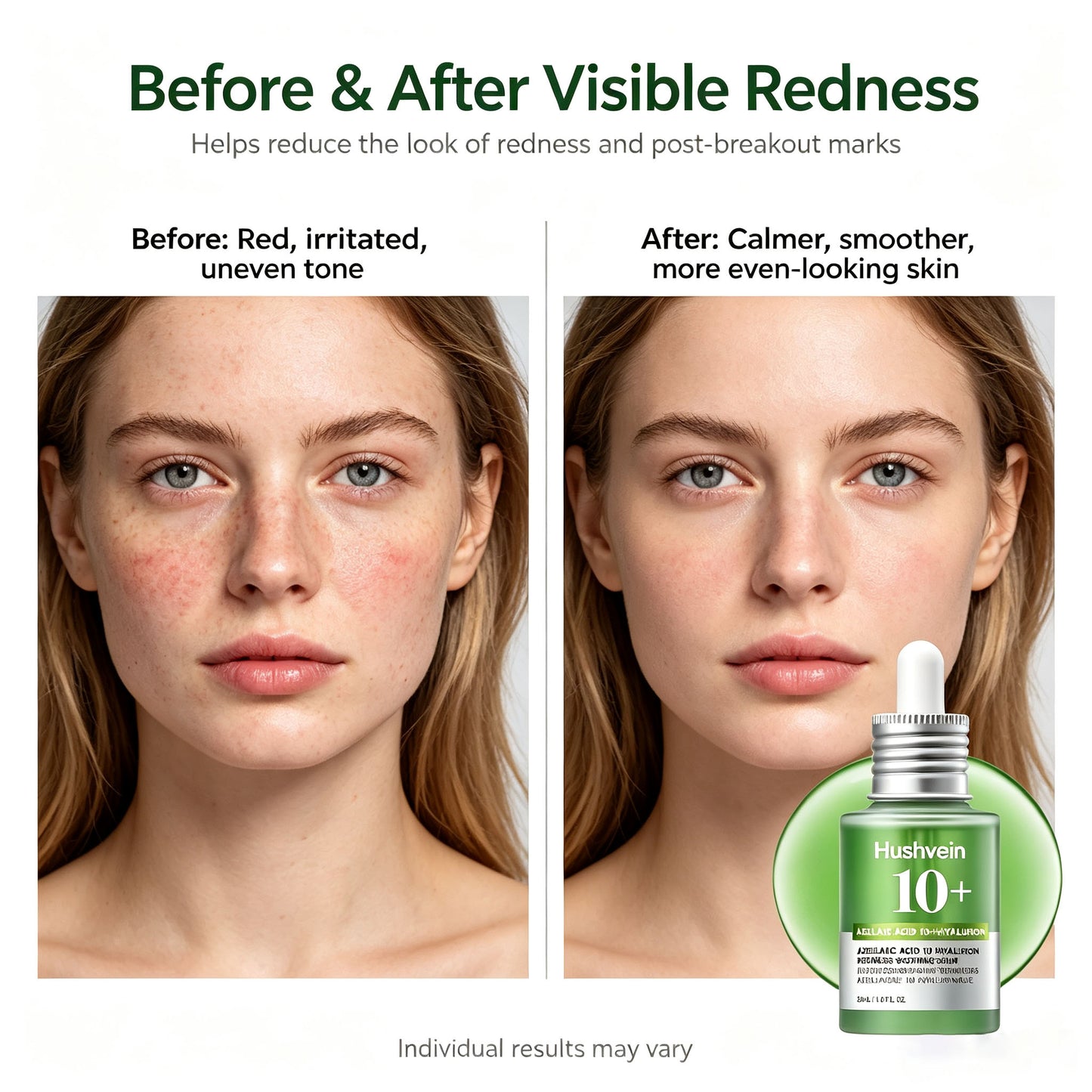 Hushvein 10% Azelaic Acid & Hyaluronic Acid Soothing & Redness-Relief Serum 30ml (1.01 fl.oz.) | Specially formulated for acne-prone and oily skin—soothes, reduces redness; suitable for sensitive and acne-prone skin