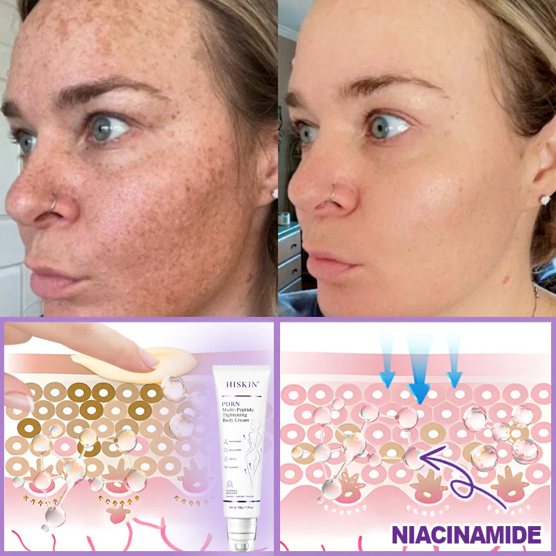 Hushvein Multi-Peptide Massaging Body Roller Cream- Anti-aging, Hydrating, Skin Firming & Lifting, Skin Repair, Even Tone, Acne and Dark Spot Treatment, Wart and Mole Removal, and Psoriasis Relief.