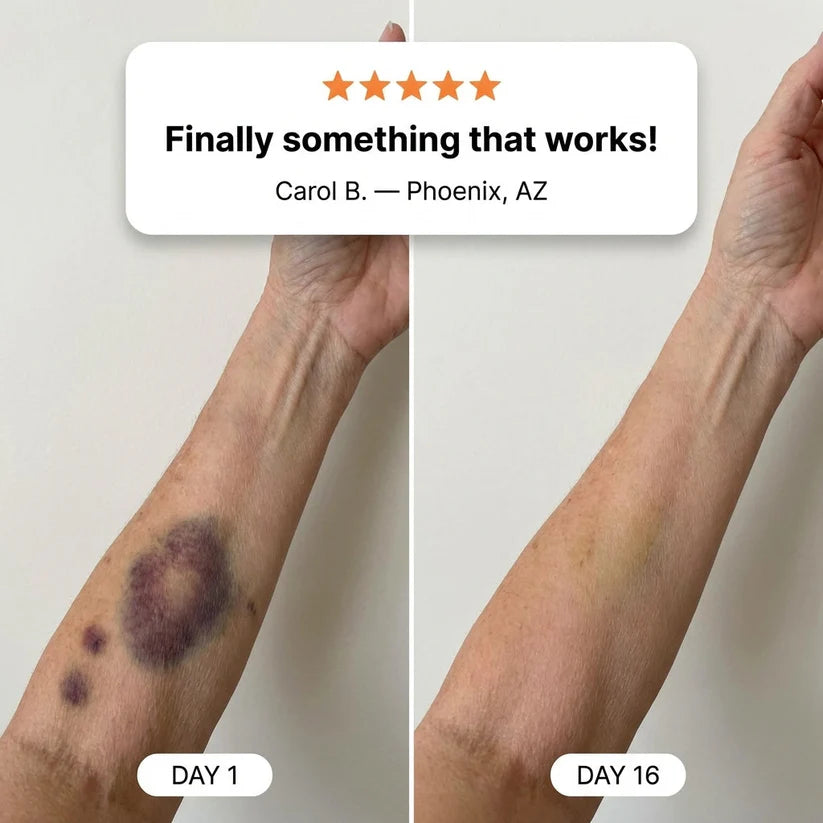 Hushvein® BRUISE REPAIR CREAM