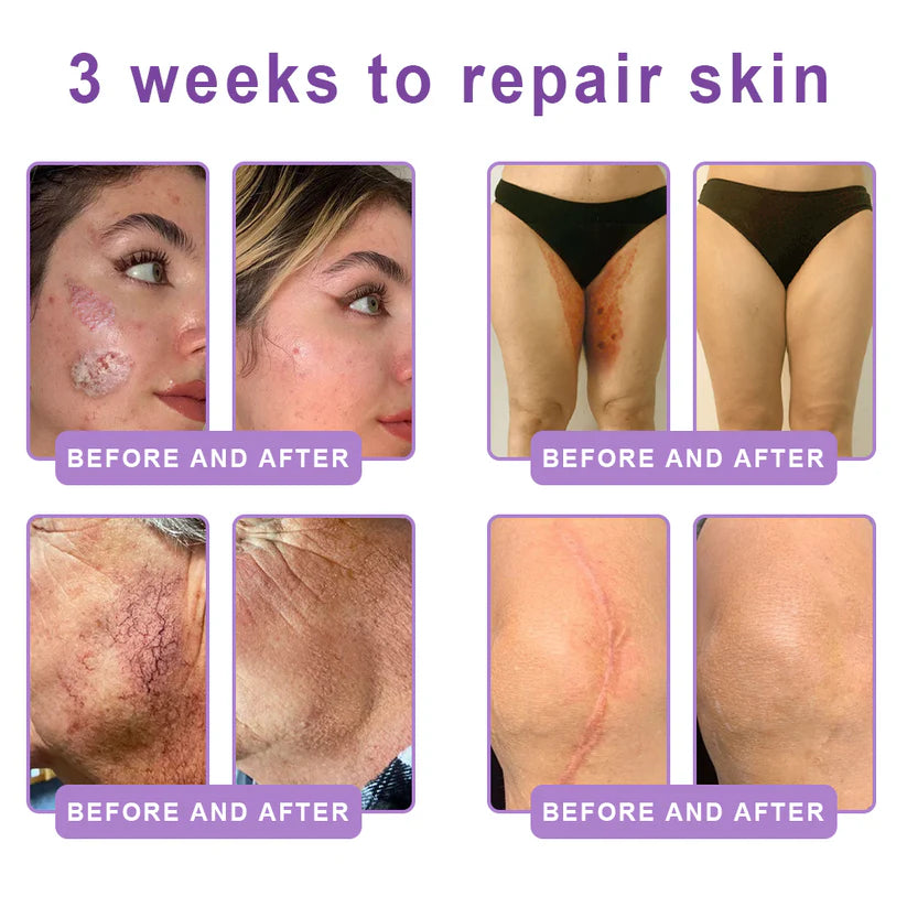Hushvein Multi-Peptide Massaging Body Roller Cream- Anti-aging, Hydrating, Skin Firming & Lifting, Skin Repair, Even Tone, Acne and Dark Spot Treatment, Wart and Mole Removal, and Psoriasis Relief.