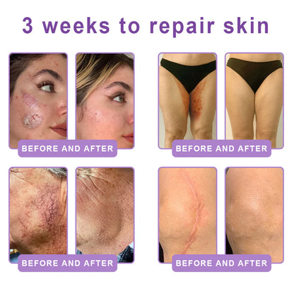Hushvein Multi-Peptide Massaging Body Roller Cream- Anti-aging, Hydrating, Skin Firming & Lifting, Skin Repair, Even Tone, Acne and Dark Spot Treatment, Wart and Mole Removal, and Psoriasis Relief.