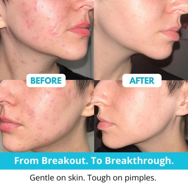 Hushvein Medical-Grade Hydrocolloid Dressing Roll – Highly absorbent and waterproof; suitable for treating burns, blisters, and acne; a first-aid kit essential.